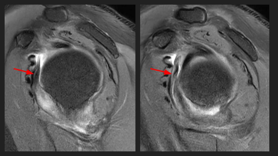 Figure 4 for case adhesive capsulitis
